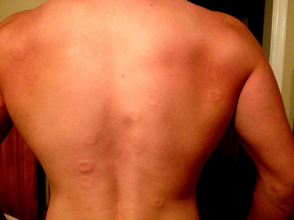 back with red bumps