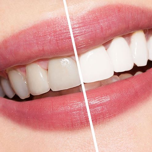 teeth whitening